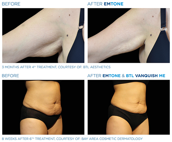 beforeafter