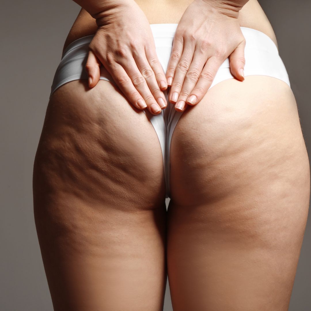 Cellulite on woman's buttocks