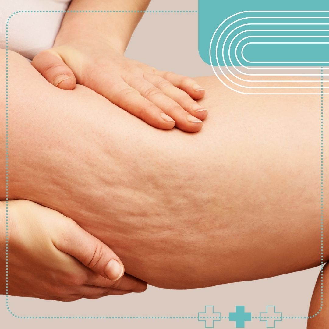 pressing leg to show cellulite