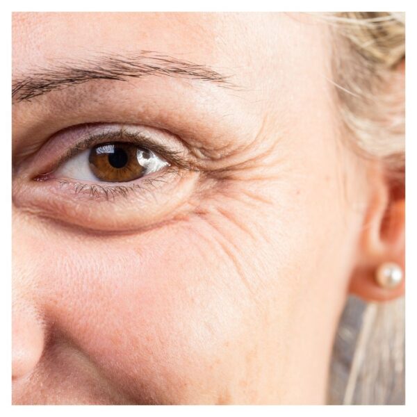 fine lines and wrinkles