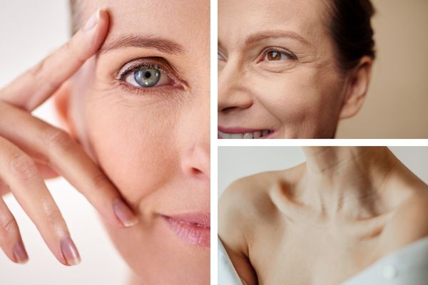 Botox 2 collage of areas prone to wrinkles around the eyes, face, and neck