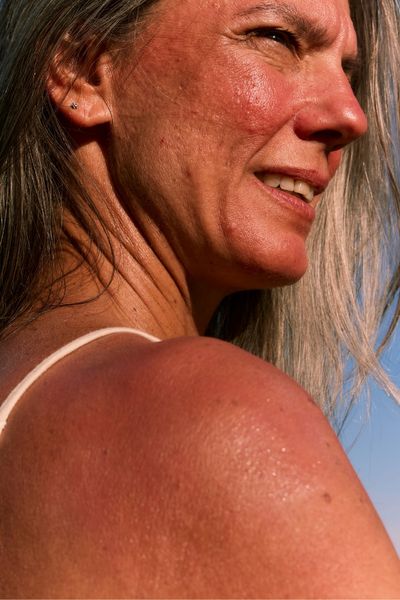 acne scarring A side-profile photograph of a middle-aged woman in warm sunlight. The image clearly shows textured skin on the cheeks and jawline, consistent with pitted acne scarring and some sun-induced redness.