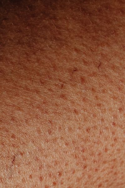 enlarged pores An extreme close-up photograph of human skin texture, showing visible, dilated pores and fine, light-colored hairs against a warm, tan skin tone.